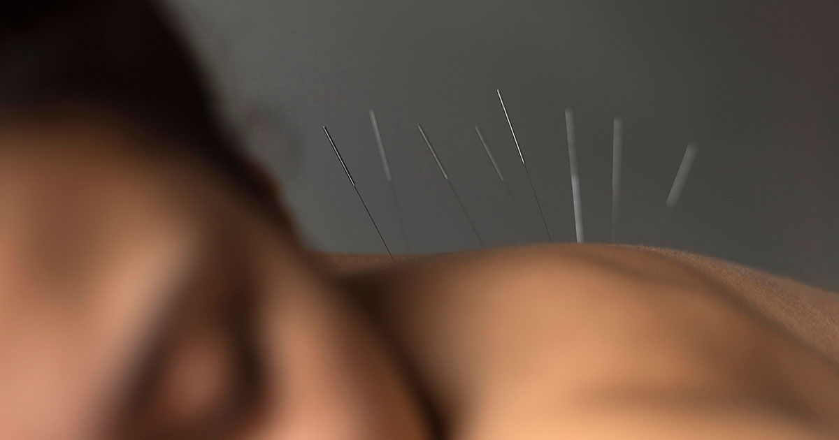 Nakkesmerter prøv akupunktur behandling