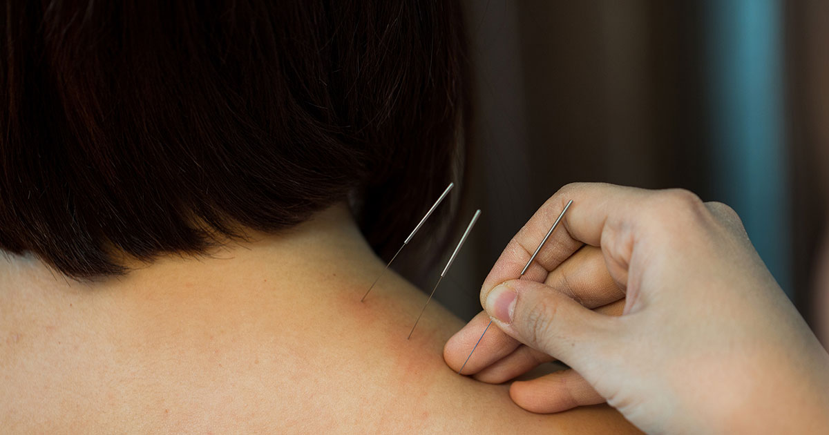 akupunktur som behandling mot nakkesmerter