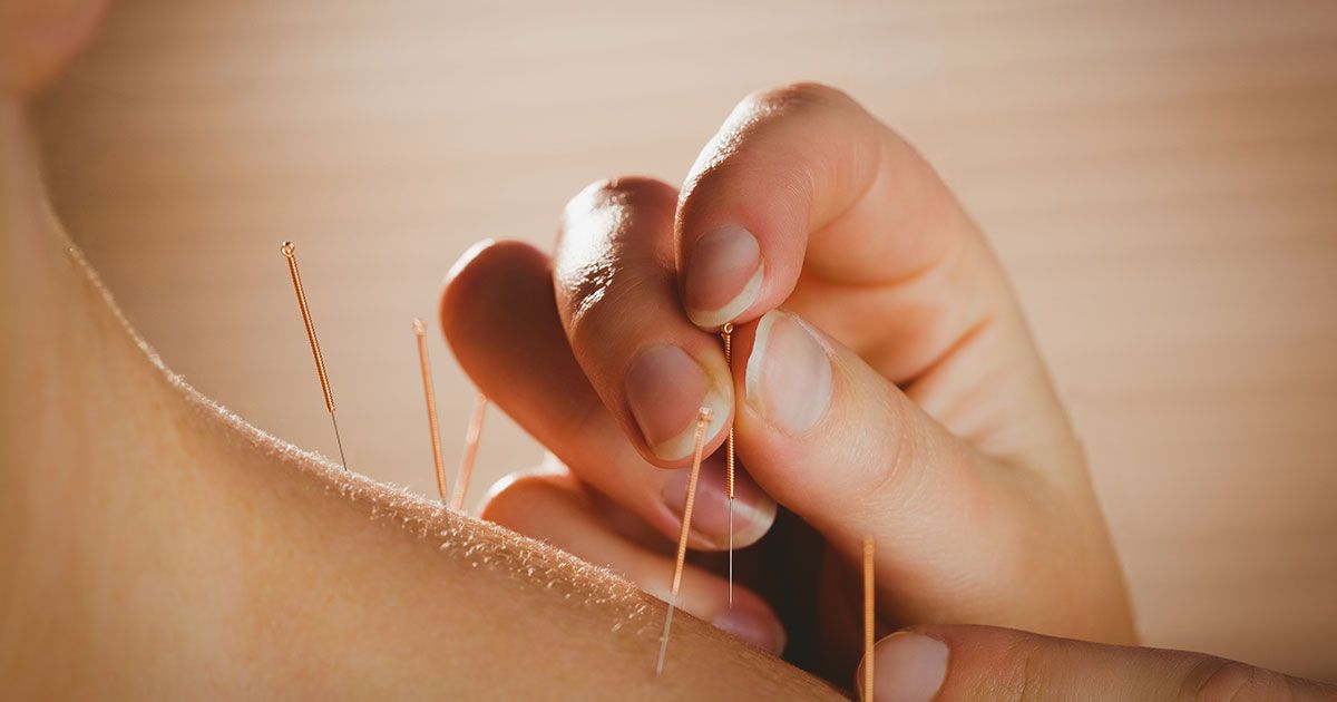 Akupunktur mot nakkesmerter