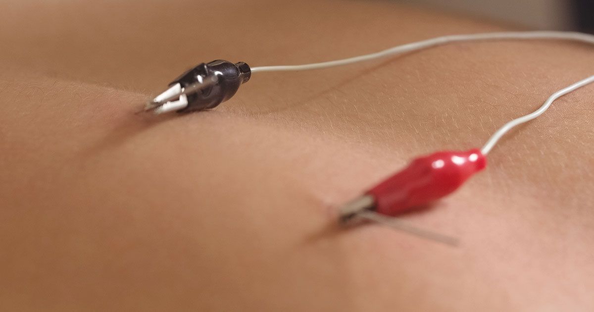 Elektro-akupunktur